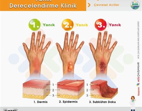 Yanık Vakalarında Acil Müdahale ve Tedavi Yöntemleri
