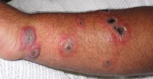 Şarbon Nedir ?,Ebola Virüsü Hastalığı